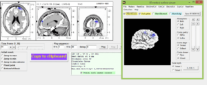 LORETA Neurofeedback in Northeim